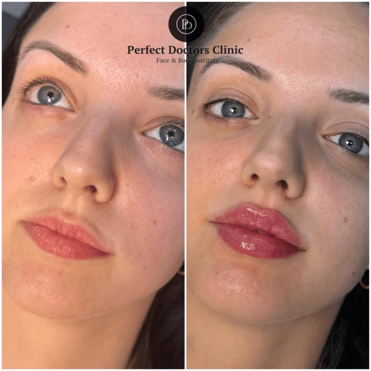 Juvederm in Dubai: Addressing Signs of Aging Early