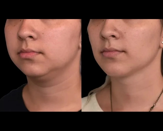 How to Choose the Right Size for Double chin removal Surgery in dubai